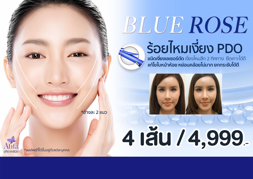 รีวิว-ร้อยไหม-ปรับรูปหน้ายกกระชับ-ใช้ไหมกี่เส้น-เห็นผลแค่ไหน-ไหม-Blue-Rose