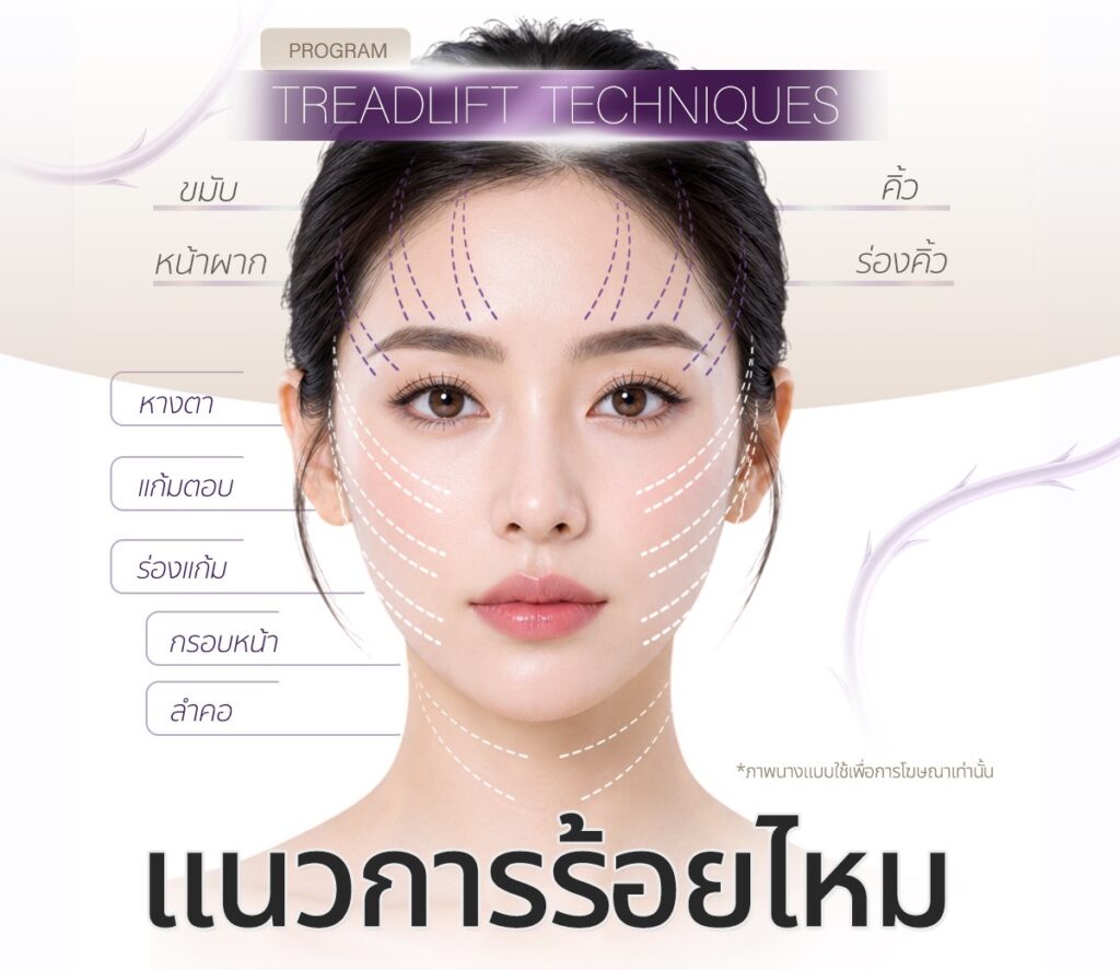 แนวการร้อยไหม อทิตาคลินิก